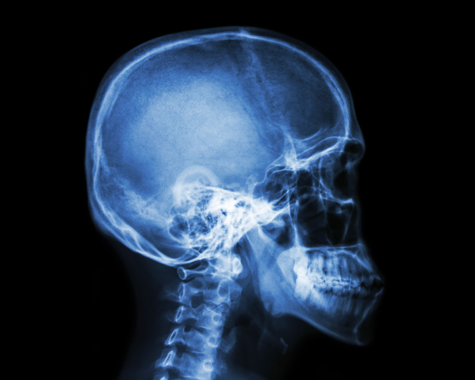 Une radiographie par rayon X du crâne d’un patient